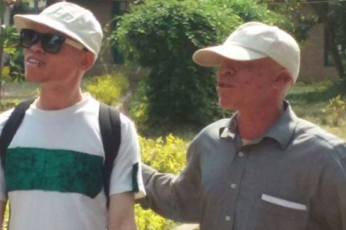 ALBINOS, CES PERSONNES QUE NOUS REGARDONS DANS LE COIN DE L'OEIL